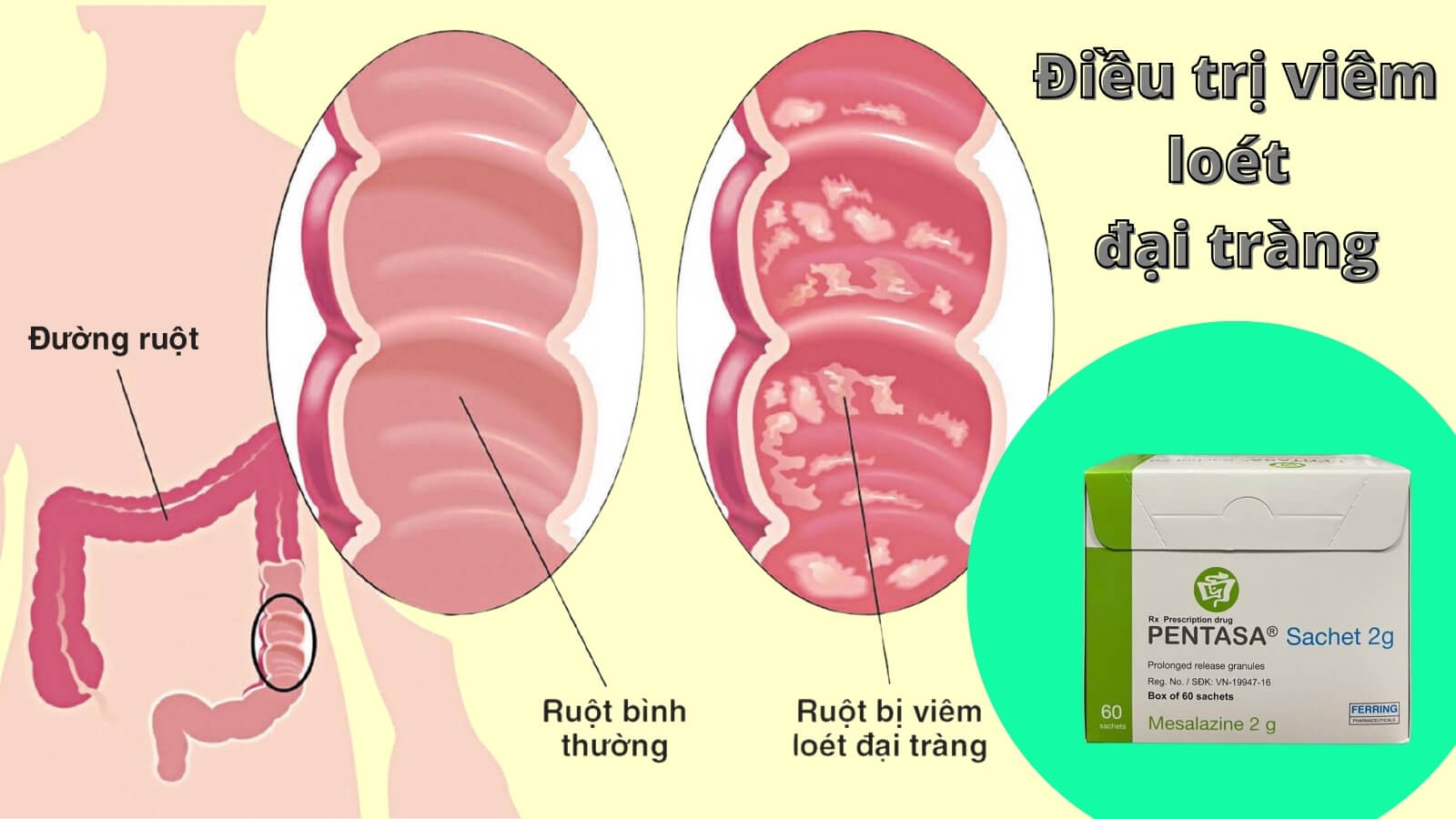 Pentasa 2g được chỉ định Bắn Cá HZ88 là trò chơi giải trí điện tử vi&ecirc;m lo&eacute;t đại tr&agrave;ng
