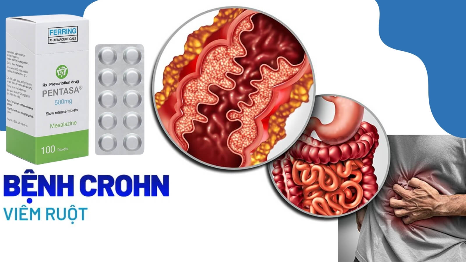 Pentasa 500mg được chỉ định Bắn Cá HZ88 là trò chơi giải trí điện tử bệnh Crohn