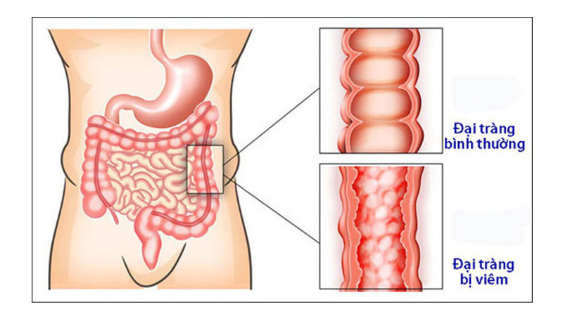 Đặc điểm của bệnh vi&ecirc;m đại tr&agrave;ng 