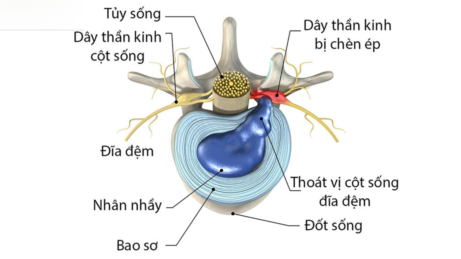 Tho&aacute;t vị đĩa đệm g&acirc;y ch&egrave;n &eacute;p d&acirc;y thần kinh cột sống